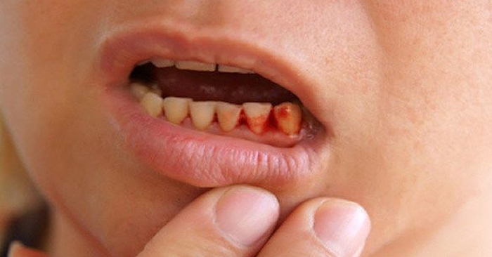 Trẻ em bị chảy máu chân răng – Nguyên nhân và cách điều trị
