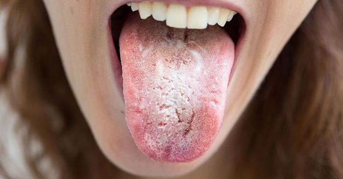 Đẹn miệng là gì? Cách chữa trị nổi đẹn trong miệng