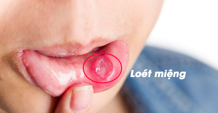 Bị lở miệng (viêm loét miệng) – Nguyên nhân và cách chữa trị