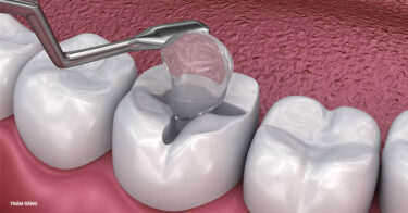 Có nên trám răng sâu không? Phương pháp nào vừa bền vừa rẻ?