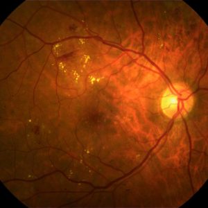 Bệnh võng mạc đái tháo đường, nguyên nhân và cách điều trị bệnh