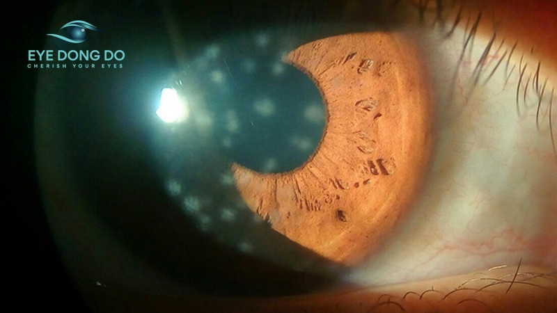 Đôi mắt viêm giác mạc chấm nông