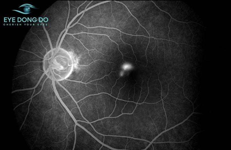 Không có nguyên nhân chính xác gây ra bệnh hắc võng mạc trung tâm thanh dịch