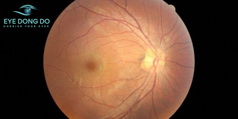 Bệnh hắc võng mạc trung tâm thanh dịch