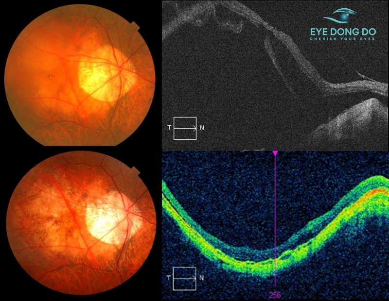 Điều trị bệnh hắc võng mạc trung tâm thanh dịch