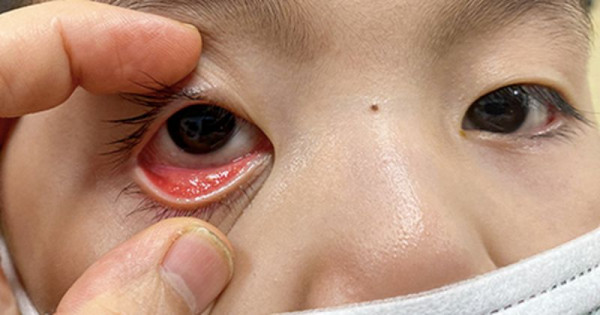 Bệnh khô mắt ở trẻ có thể xảy ra do viêm kết mạc
