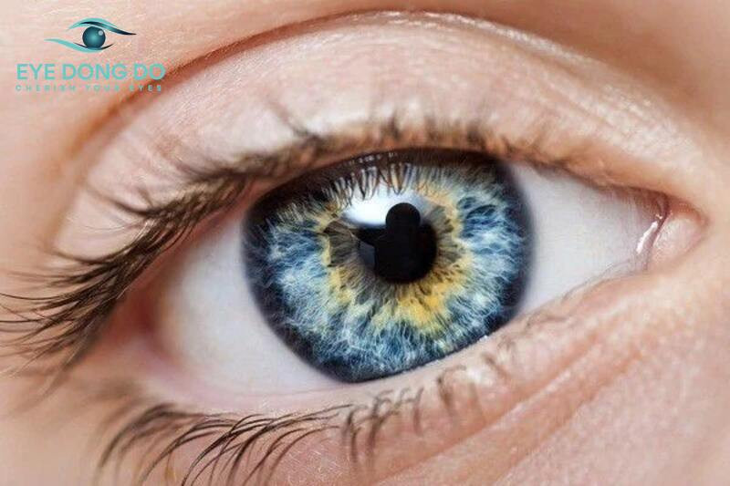 Bệnh mù màu do nhiều nguyên nhân tác động