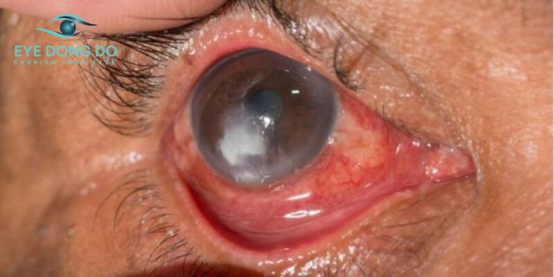 Dấu hiệu của bệnh nấm mắt