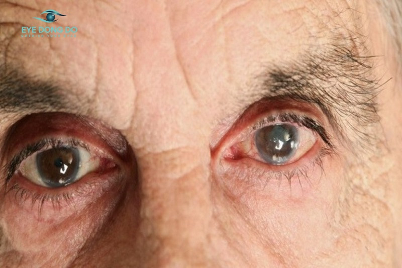 Đối tượng cao tuổi là những người dễ bị bệnh tăng nhãn áp