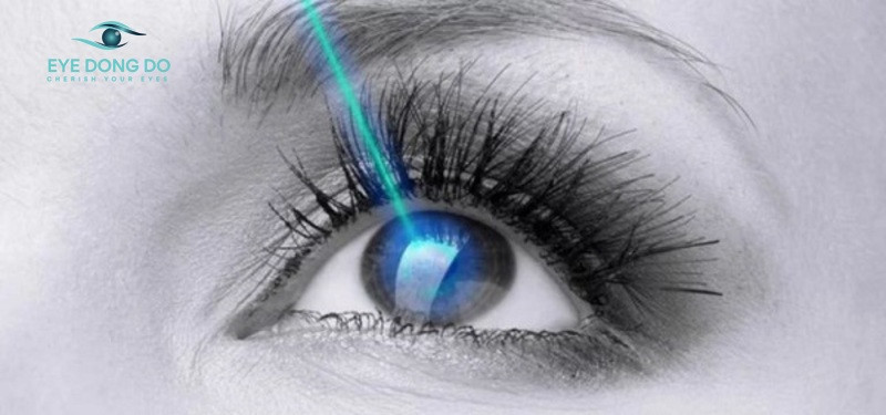 Điều trị bệnh tăng nhãn áp bằng laser