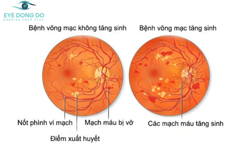 Nguyên nhân gây ra bệnh võng mạc tiểu đường là do biến chứng mắc tiểu đường tác động