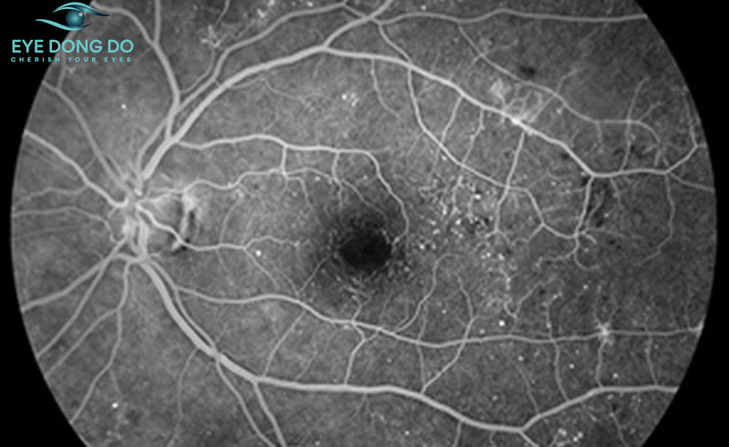 Chụp mạch máu huỳnh quang xem xét các tổn thương về mạch máu