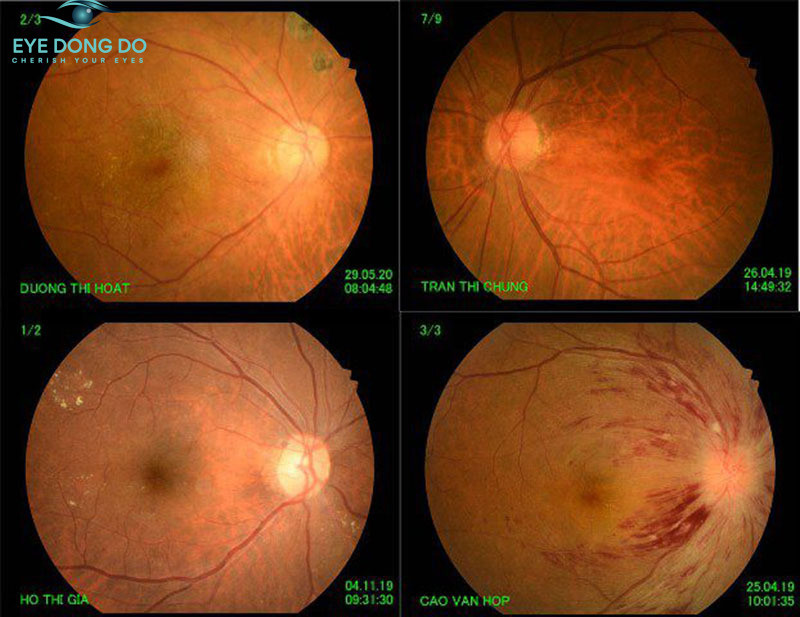 Chụp hình màu đáy mắt để nhận định các tổn thương giai đoạn sớm