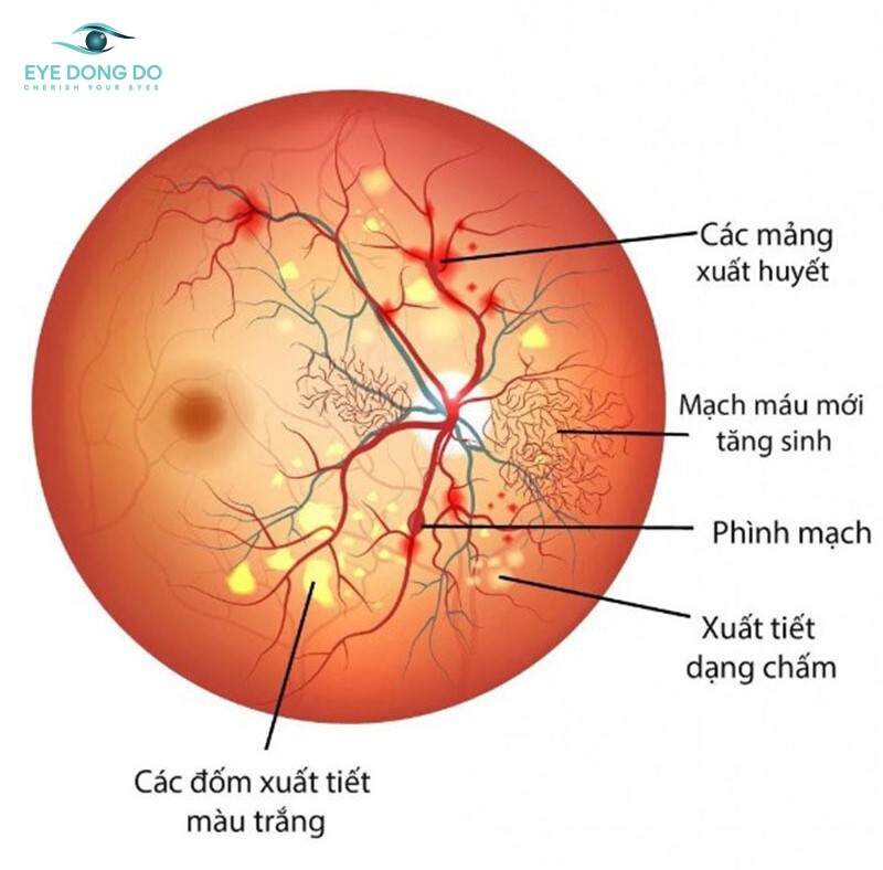 Bệnh võng mạc tiểu đường – Các giai đoạn và biến chứng