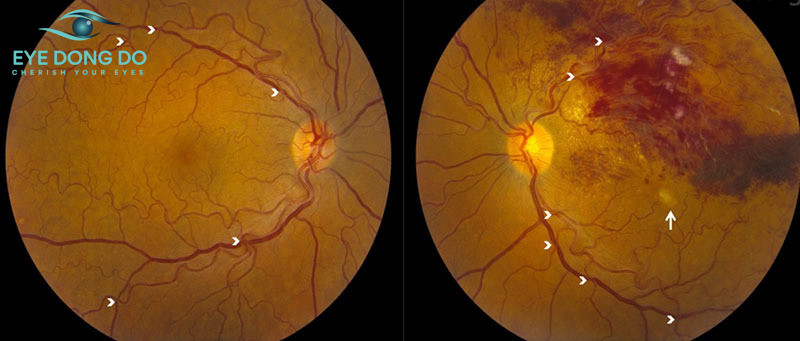 Võng mạc đái tháo đường gây tổn thương cho mạch máu và mô võng mạc