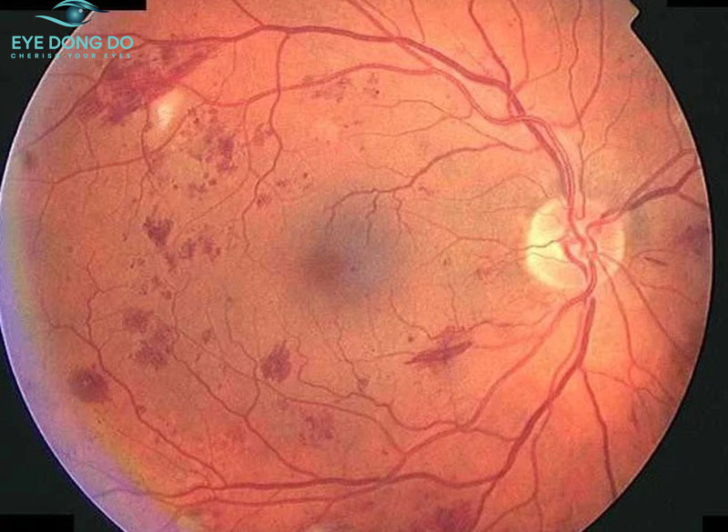 Bệnh võng mạc đái tháo đường gây rách hoặc bong võng mạc