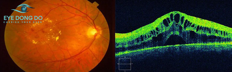 Bệnh lý hoàng điểm là nguyên nhân phổ biến gây giảm thị lực