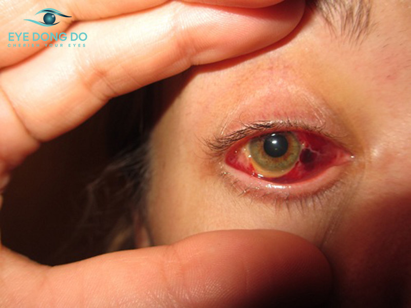 Biến chứng sau mổ đục thủy tinh thể khiến võng mạc bị  bong ra gây mất thị lực