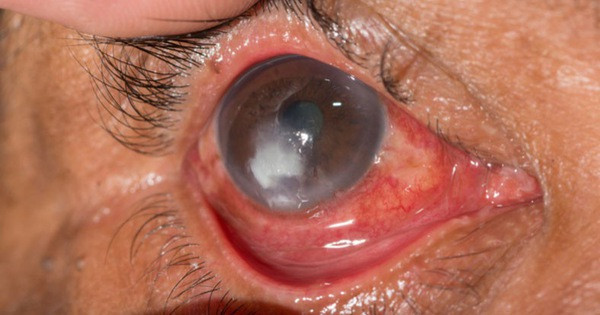 Hình ảnh mắt bị viêm loét giác mạc, biến chứng sau mổ mộng thịt