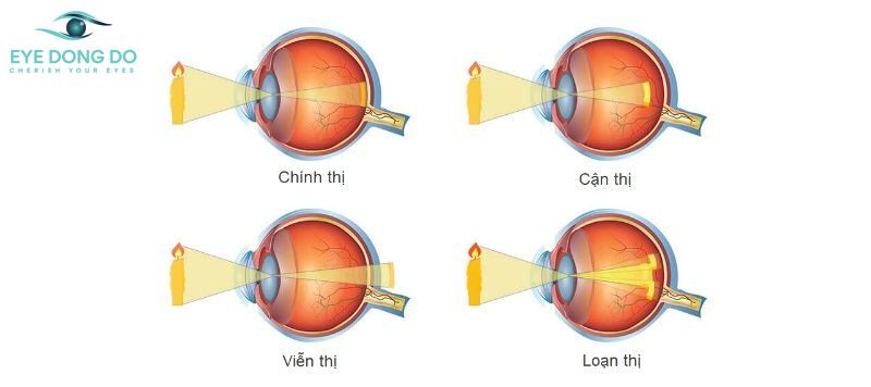 Mắc tật khúc xạ là một trong các bệnh về mắt rất phổ biến hiện nay