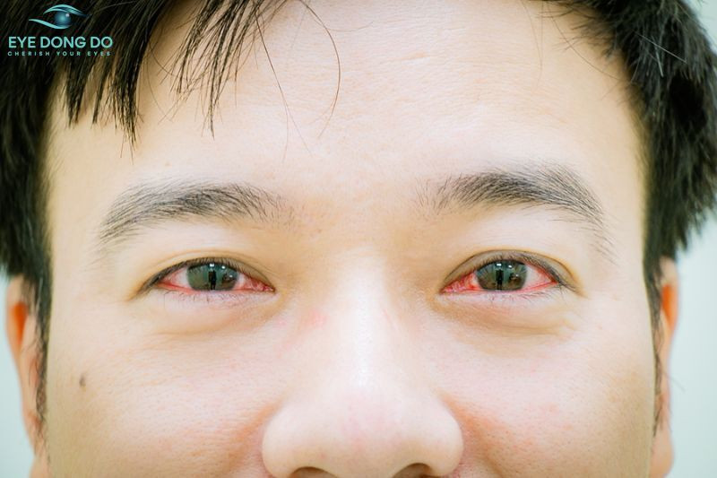 Đau mắt đỏ xảy ra do nhiều nguyên nhân khác nhau
