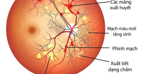 Võng mạc đái tháo đường là bệnh lý nguy hiểm ở người già