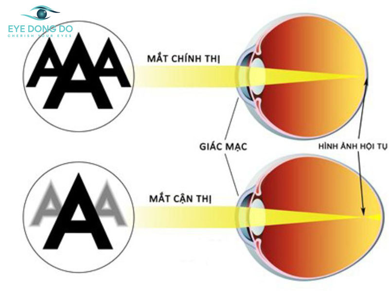 Cận thị là bệnh lý về mắt ở trẻ em thường gặp