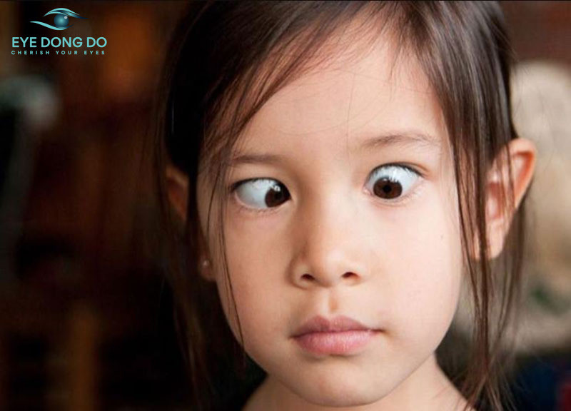 Trẻ em bị lác mắt cũng có tỉ lệ mắc khá cao