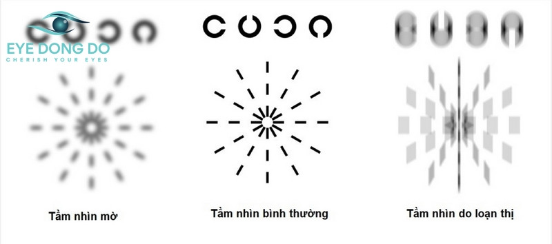 Những cách chữa loạn thị phổ biến nhất hiện nay