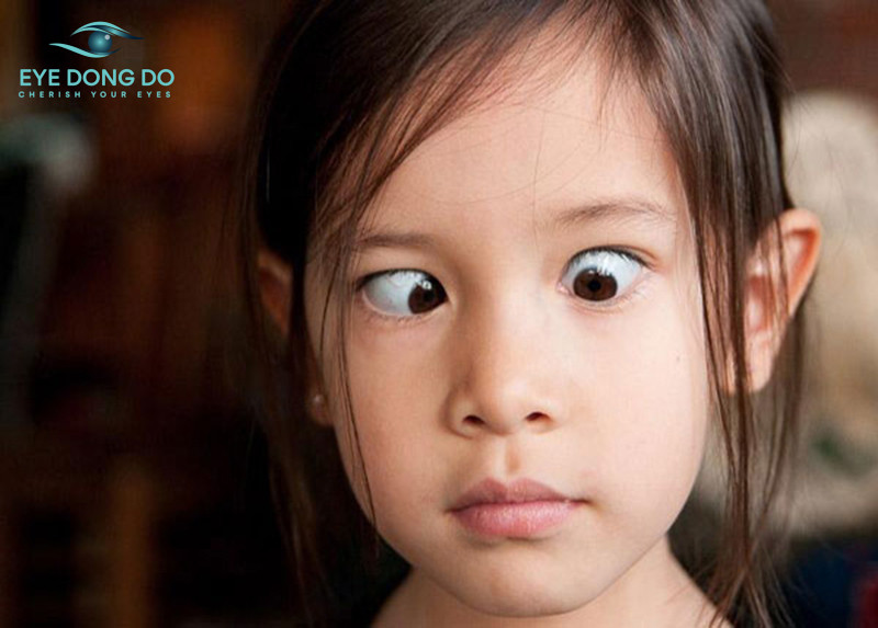 Cách chữa mắt lác tại nhà bằng các bài tập hỗ trợ đơn giản