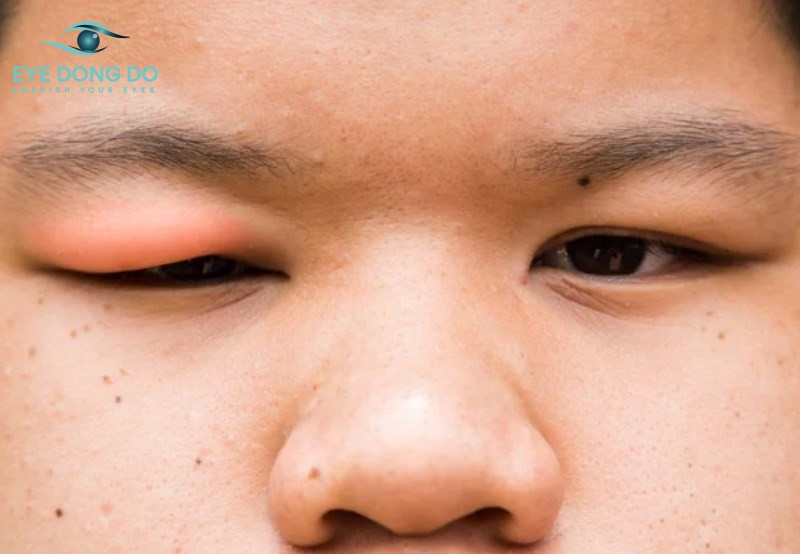 Sưng mắt do nhiều nguyên nhân từ vô hại đến nghiêm trọng