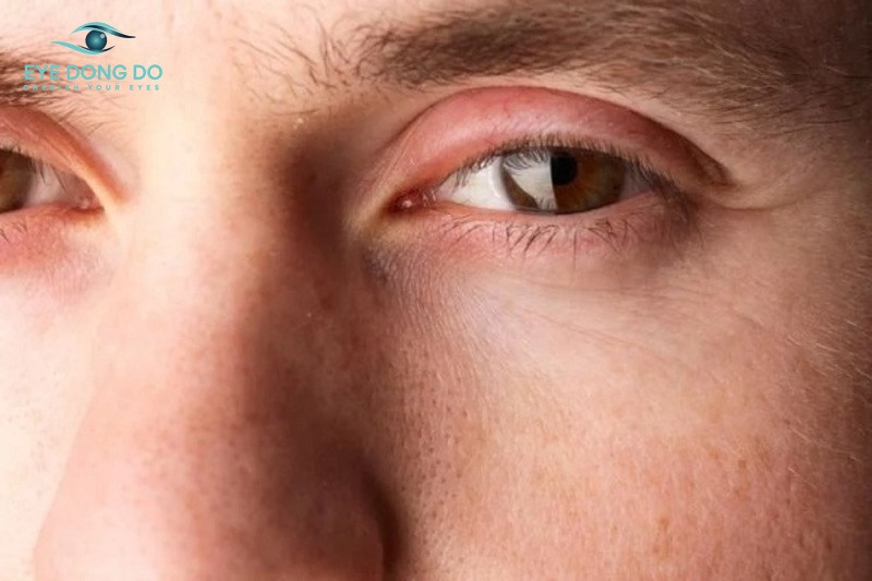 Sưng mí mắt là tình trạng rất phổ biến hiện nay