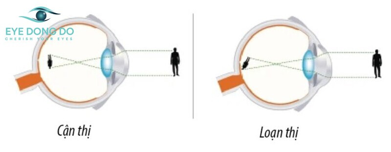 Phân biệt cận thị và lão thị