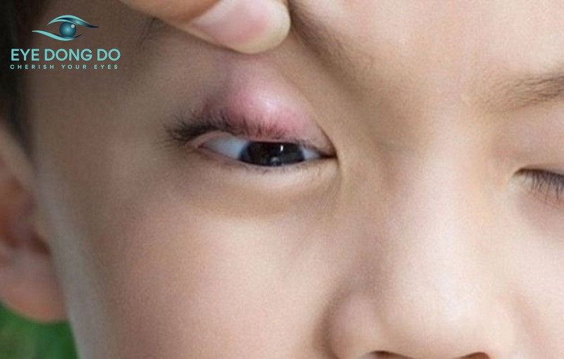 Khi bị chắp mắt người bệnh xuất hiện những nốt sưng đỏ ở vùng da mí trên, dưới