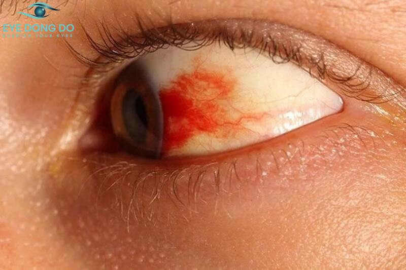 Xuất huyết kết mạc là một dạng chảy máu mắt
