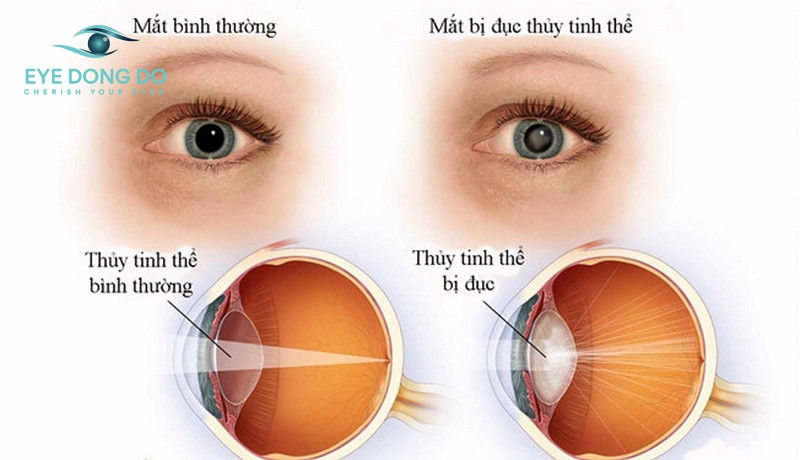 Bệnh cườm khô hay còn gọi là đục thủy tinh thể 