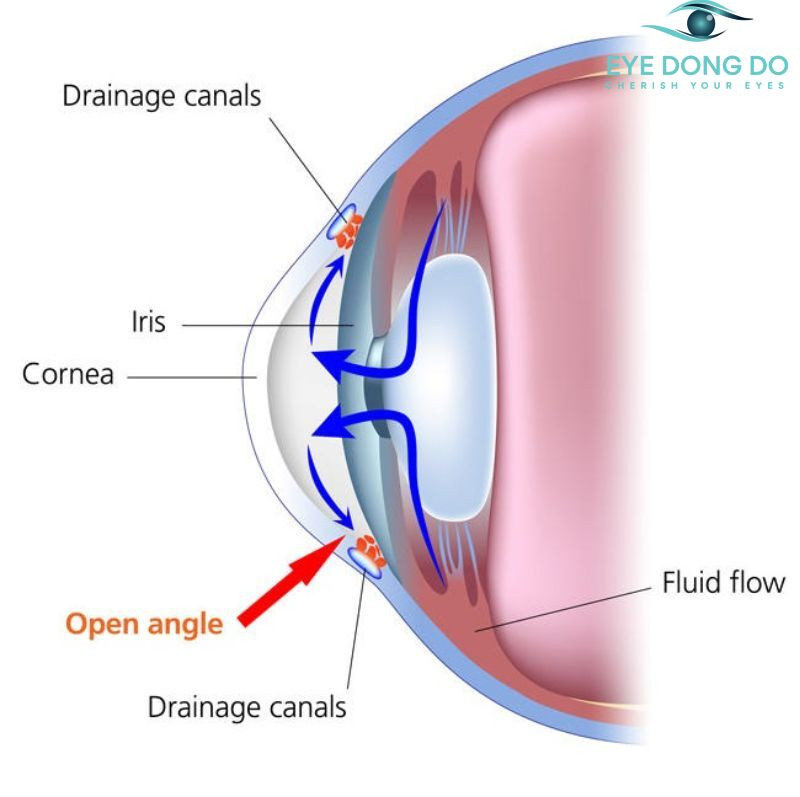Cườm nước kéo dài có thể dẫn tới mù lòa