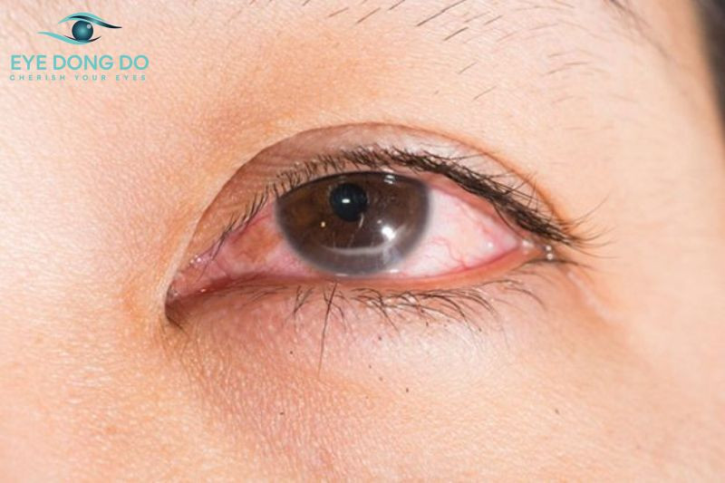 Cườm nước góc đóng thường đi kèm tình trạng đau đầu, đau mắt