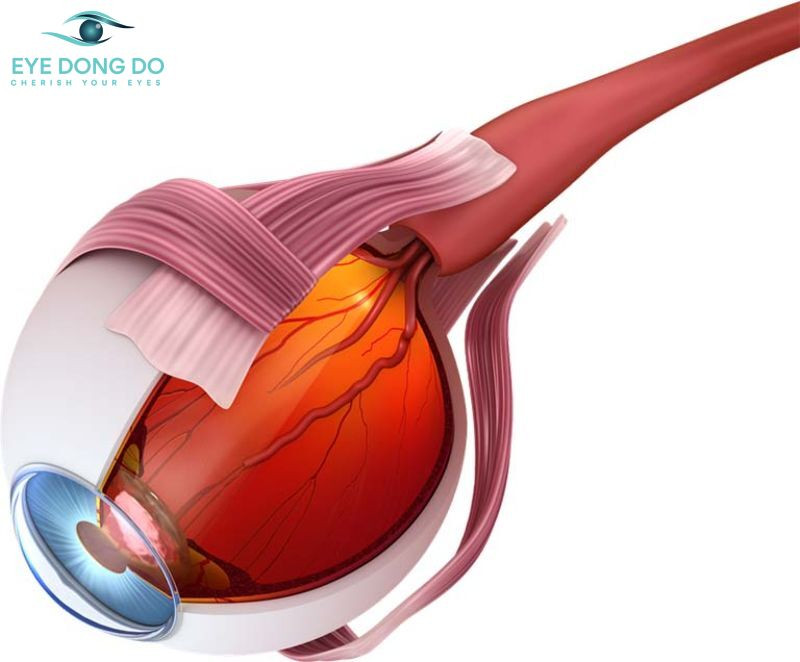 Tăng nhãn áp 9cườm nước) có liên quan tới tình trạng giảm lưu lượng máu nuôi dưỡng dây thần kinh thị giác