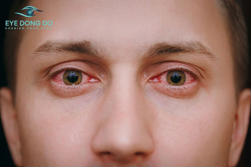 Bị đau mắt đỏ bao lâu thì khỏi? Cách điều trị và phòng ngừa