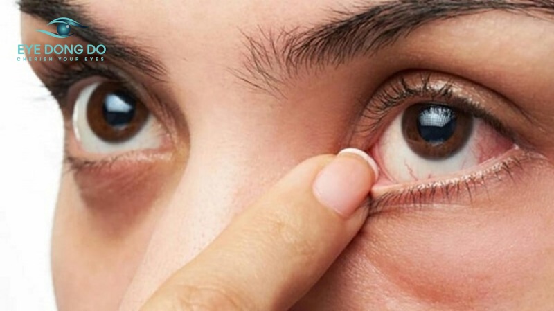 Cách xử lý dị vật tại nhà