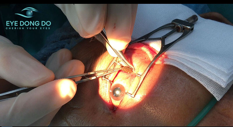 Dị vật trong mắt là vật thể xâm nhập từ bên ngoài