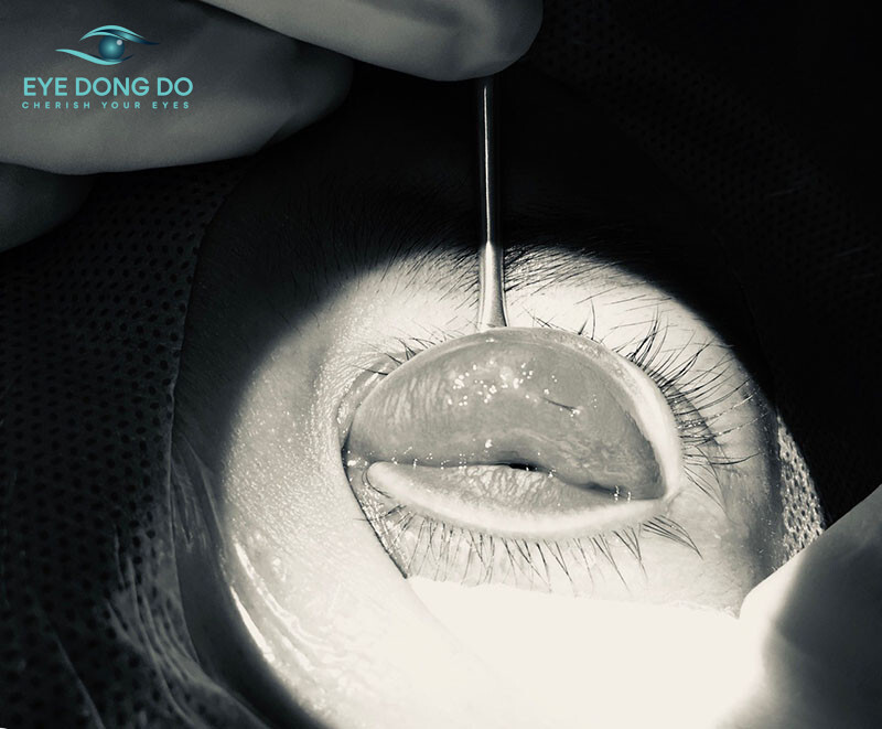 Dị vật trong mắt không lấy ra khỏi mắt rất dễ để lại những biến chứng nguy hiểm