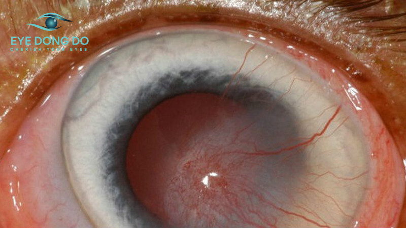 Dị vật trong mất gây cảm giác vô cùng khó chịu