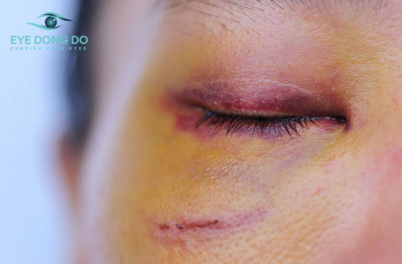 Có nhiều nguyên nhân làm dị vật trong mắt