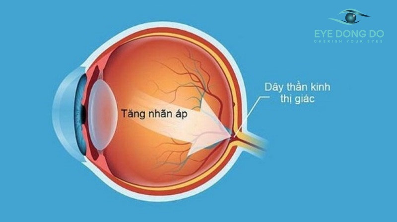 Tăng nhãn áp gây tổn thương dây thần kinh thị giác