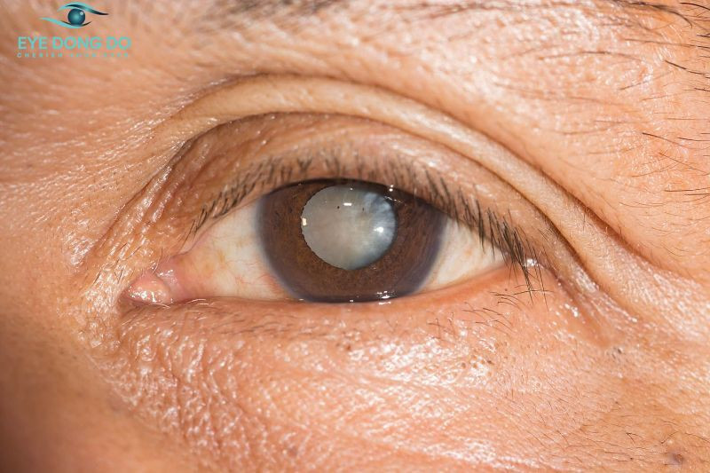 Đục bao sau là tình trạng không hiếm gặp