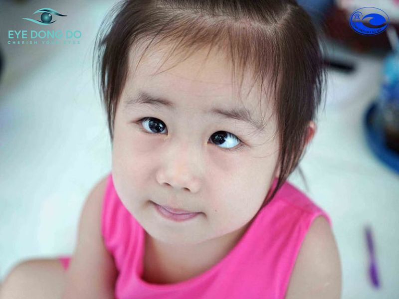 Trẻ bị lác có thể do đục thủy tinh thể bẩm sinh