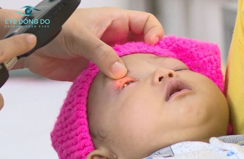 Đục thủy tinh thể cực sau có ranh giới rõ ràng