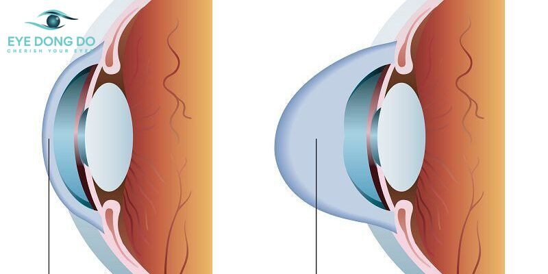 Giác mạc hình chóp – Do đâu và triệu chứng thường gặp